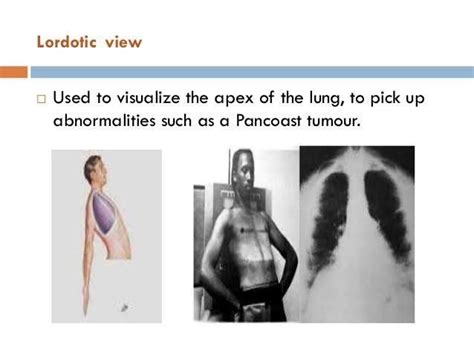 apicolordotic|apicolordotic view position.